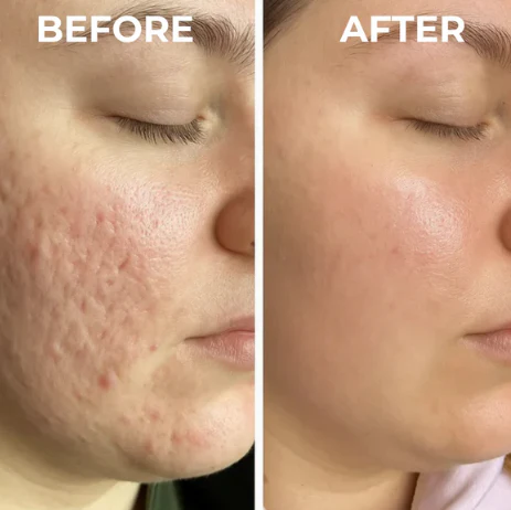 Dual Action Real Deep Collagen Sheets for both wrinkle smoothing and new or old scar fading