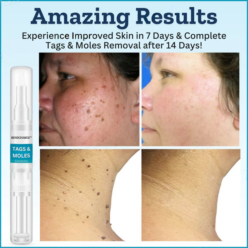 BENDCHARGE™ Tags & Moles Corrector