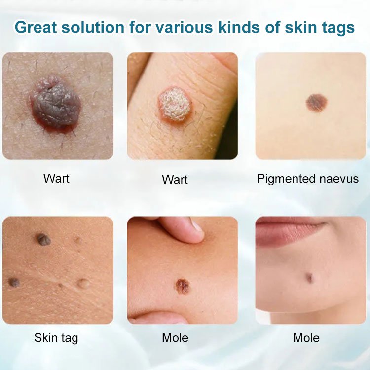 🔥LAST DAY 70% OFF🔥Concentrated Potent Skin Tag Removal Cream