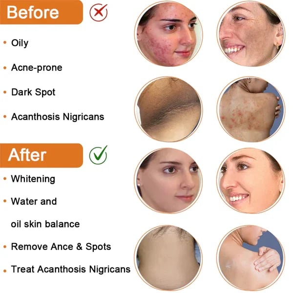 🔥LAST DAY 50% OFF🔥Brown-atto™ Cleansing Lotion for Acne & Spots & Acanthosis Nigricans