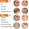 🔥LAST DAY 50% OFF🔥Brown-atto™ Cleansing Lotion for Acne & Spots & Acanthosis Nigricans