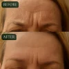 Dual Action Real Deep Collagen Sheets for both wrinkle smoothing and new or old scar fading