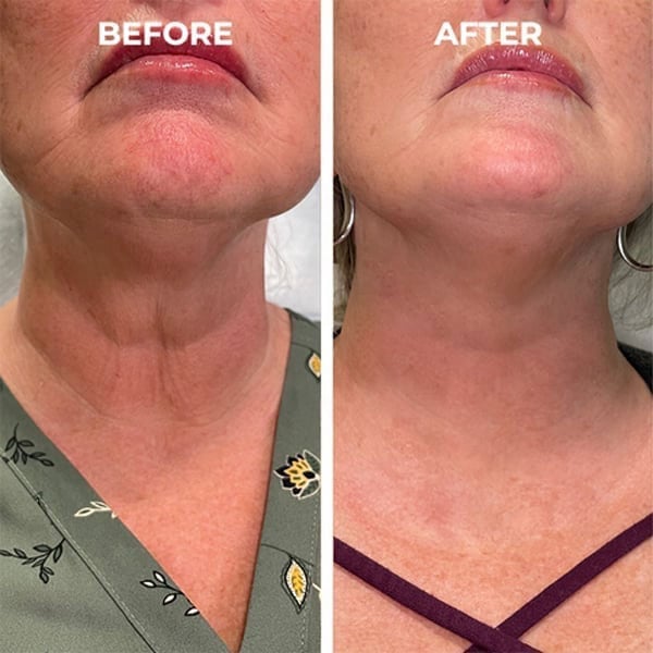 Last Day Promotion 49% OFF - 🔥Botox Face Serum