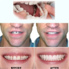 Last Day Promotion 70% OFF - 🔥Adjustable Teeth Veneers Dentures