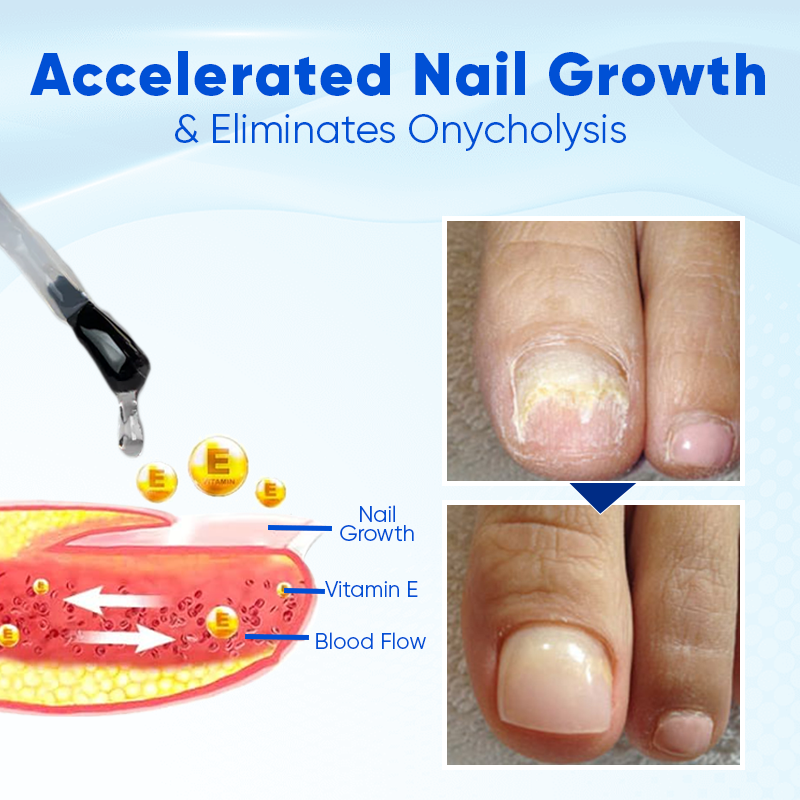 Last Day Promotion 70% OFF - 🔥OnyxoGuard Nail Growth and Repair Serum