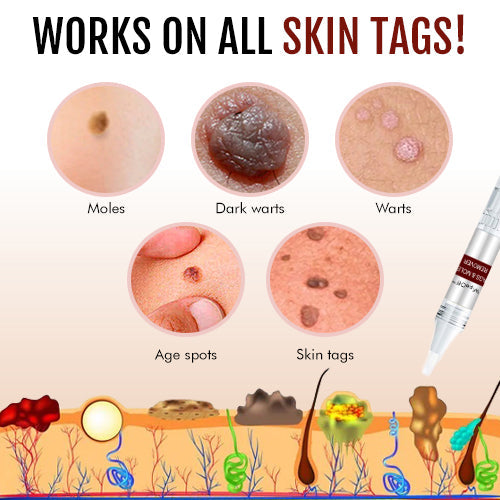 🔥Limited Time Sale 48% OFF🎉WipeOff™ Tags & Moles Remover