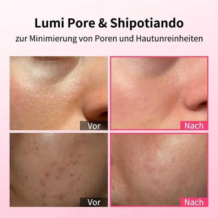 🔥Letzter Tag 49% Rabatt✨Klare‑Haut Pflege‑Duo