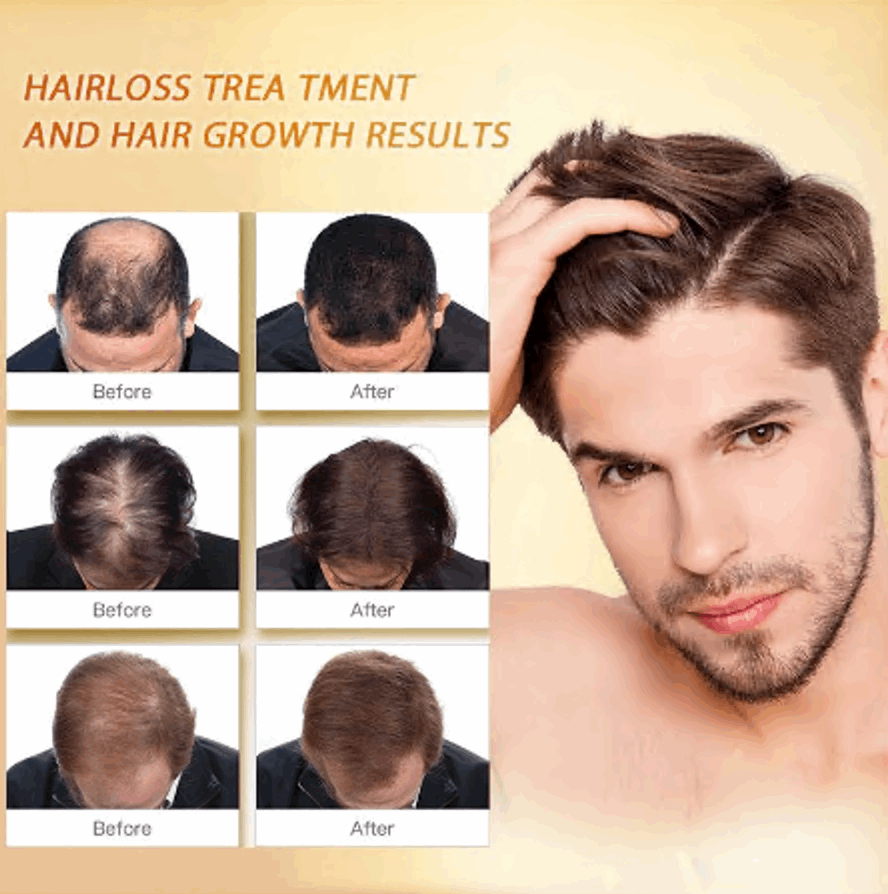 PURC Hair Regrowth Treatment - Anti Hair Loss & Hair Growth