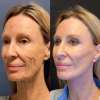 ⏰Last Day Discount 70% Off -💥 Botox Face Serum