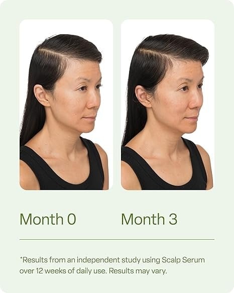 ✨LAST DAY ONLY 50% OFF🍃Divi Scalp Serum