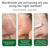 💜 LAST DAY PROMOTION - 50%💜🌿OTEH Blackhead Nose Pore Patches – Deep Cleansing & Oil Control