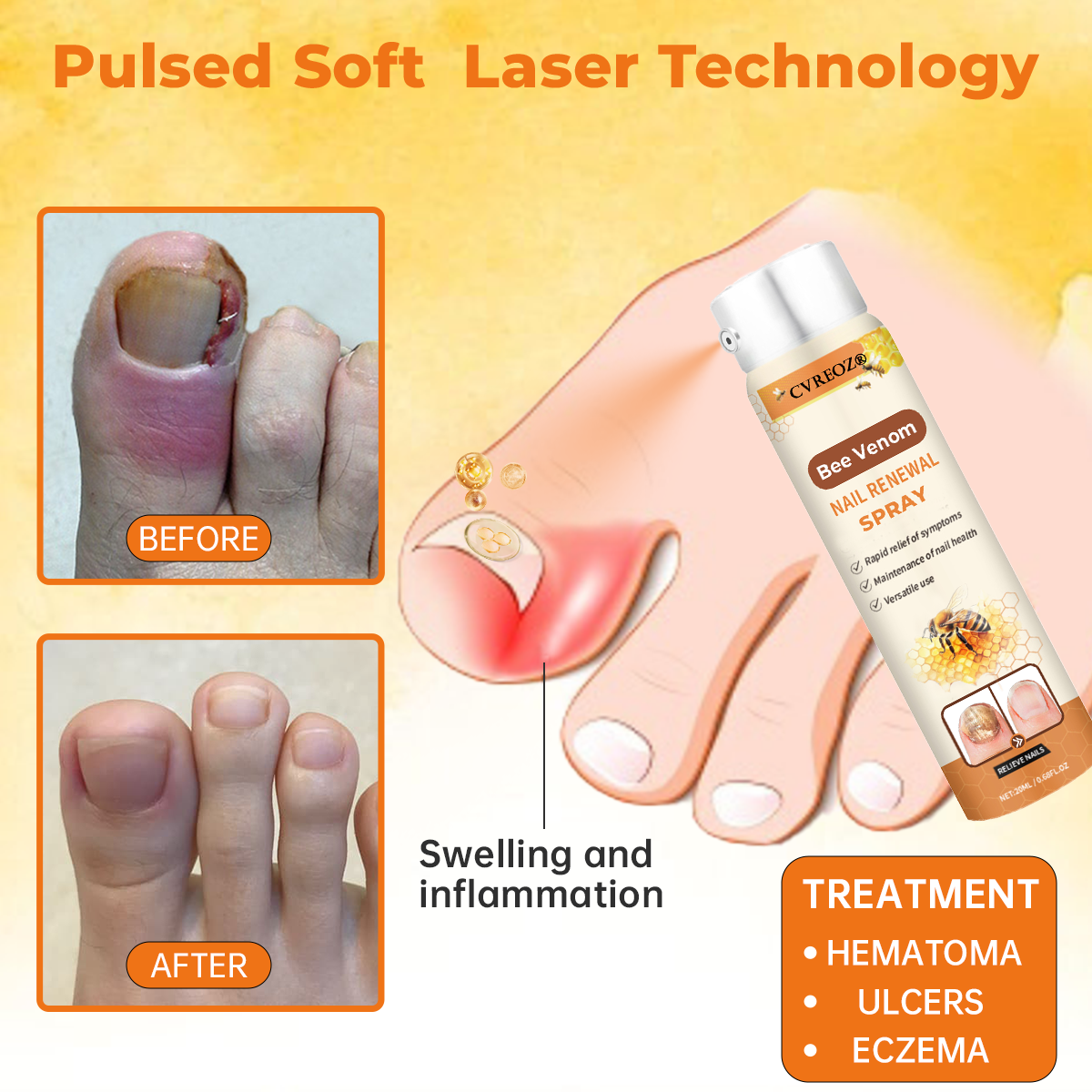🔥Last Day Promotion 70% OFF💥Cvreoz® Bee Venom Nail Renewal Spray