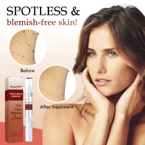 🔥Last Day Promotion 50% OFF🔥Tags & Moles Remover - Buy 2 Get 1 Free & Free Shipping