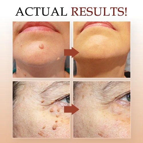 🔥Last Day Promotion 50% OFF🔥Tags & Moles Remover - Buy 2 Get 1 Free & Free Shipping