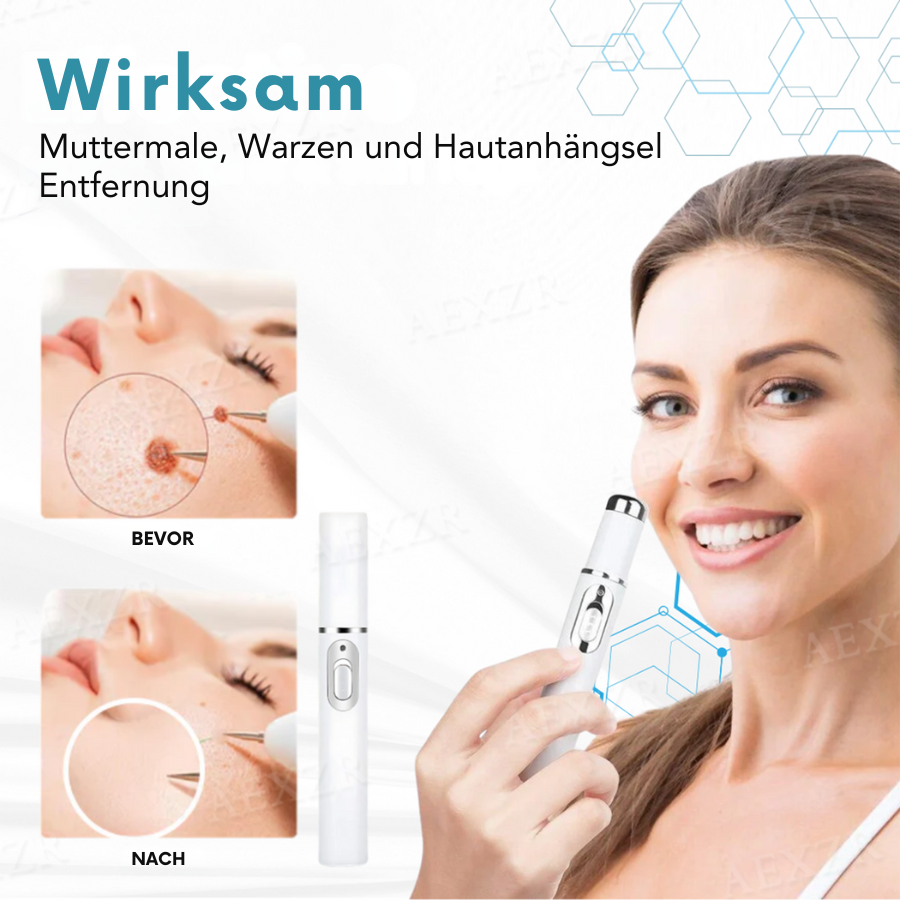 🏆Letzter Tag 49% Rabatt🔥Nicht-invasiv Leberfleck&Warzenentfernungs-Laserstift