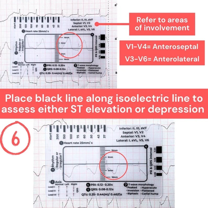 🔥LAST DAY SALE 70% OFF💥ECG 7 Step Ruler