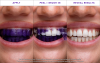 ⏰LAST DAY SALE 50% OFF💥Whitening Strips