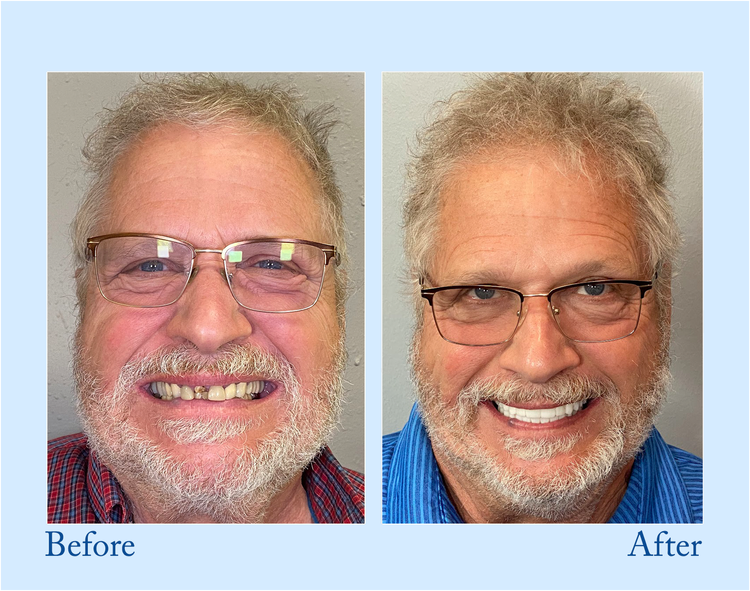 ✨Free shipping-BENDCHARGE™ - Premium Denture