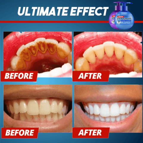 🔥Last Day Promotion 50% OFF🔥Intensive Stain Removal Whitening Toothpaste