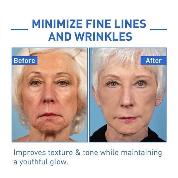 ⏰Last Day Discount 70% Off -💥 Botox Face Serum