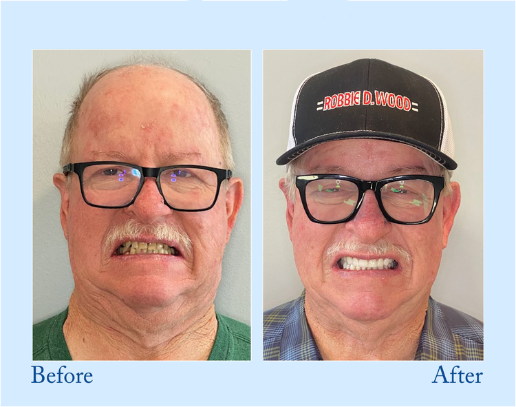 ✨Free shipping-BENDCHARGE™ - Premium Denture