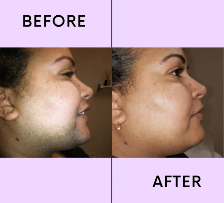💖LAST DAY 50% OFF-🔥Hair Removal Kit-Buy 1 Get 1 Free