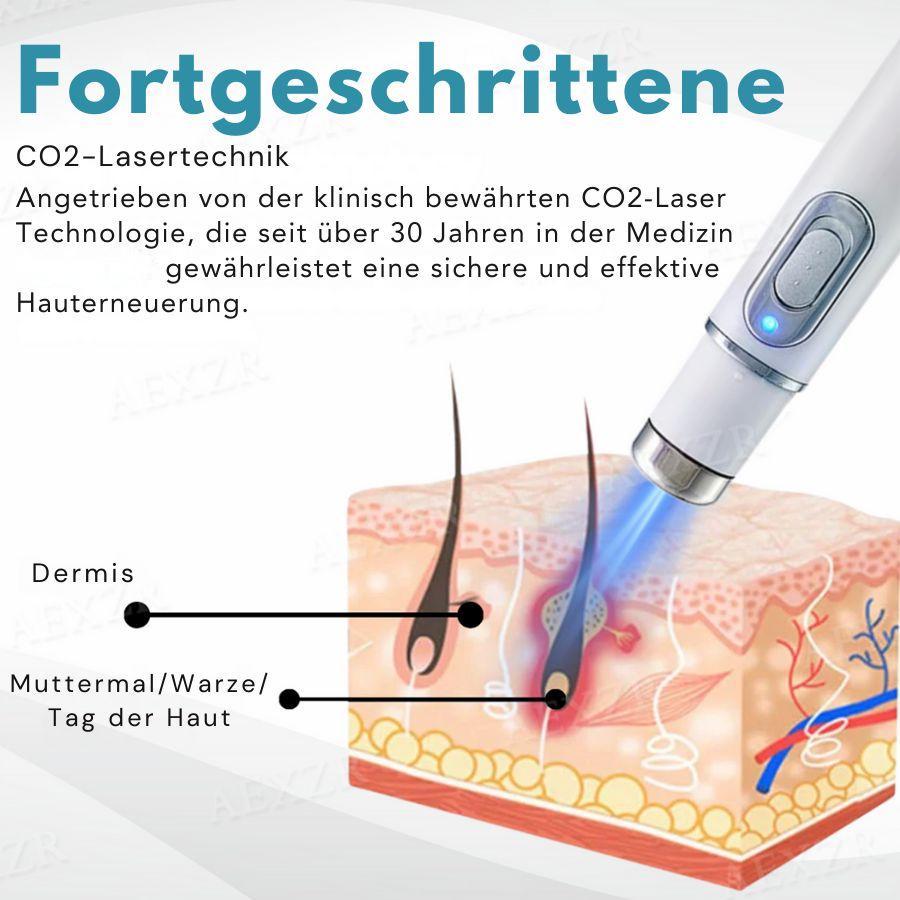 🏆Letzter Tag 49% Rabatt🔥Nicht-invasiv Leberfleck&Warzenentfernungs-Laserstift