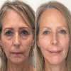 Last Day Promotion 49% OFF - 🔥2023 New Botox Face Serum