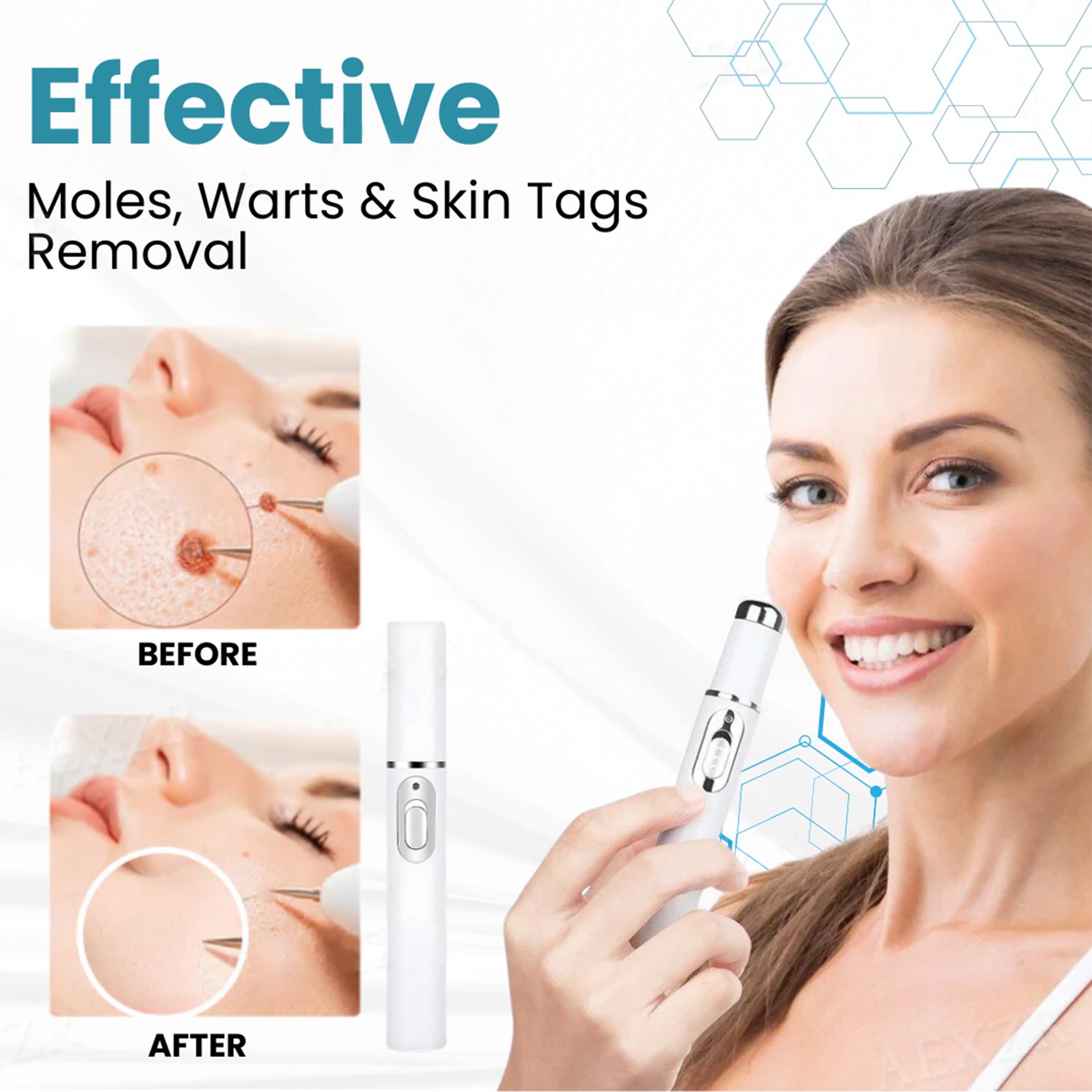 BENDCHARGE™ Non-Invasive Mole and Wart Removal Laser Pen