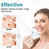 BENDCHARGE™ Non-Invasive Mole and Wart Removal Laser Pen