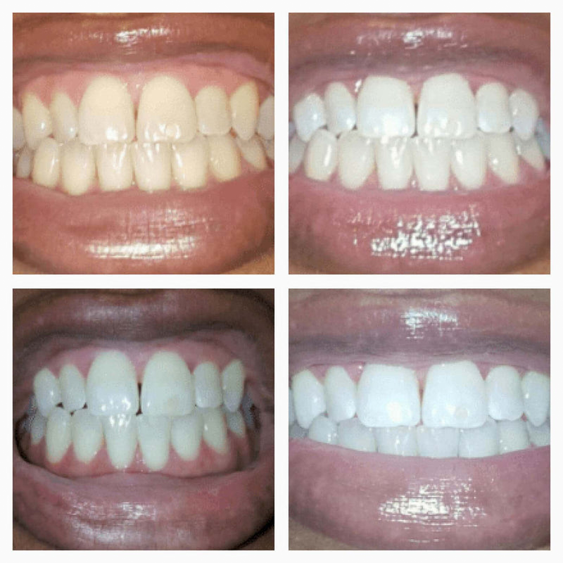 🎁TikTok Last Day Sale - 70% OFF🎉Extra-Strength Teeth Whitening Serum Pen + Dual-Peroxide Formula & Xylitol
