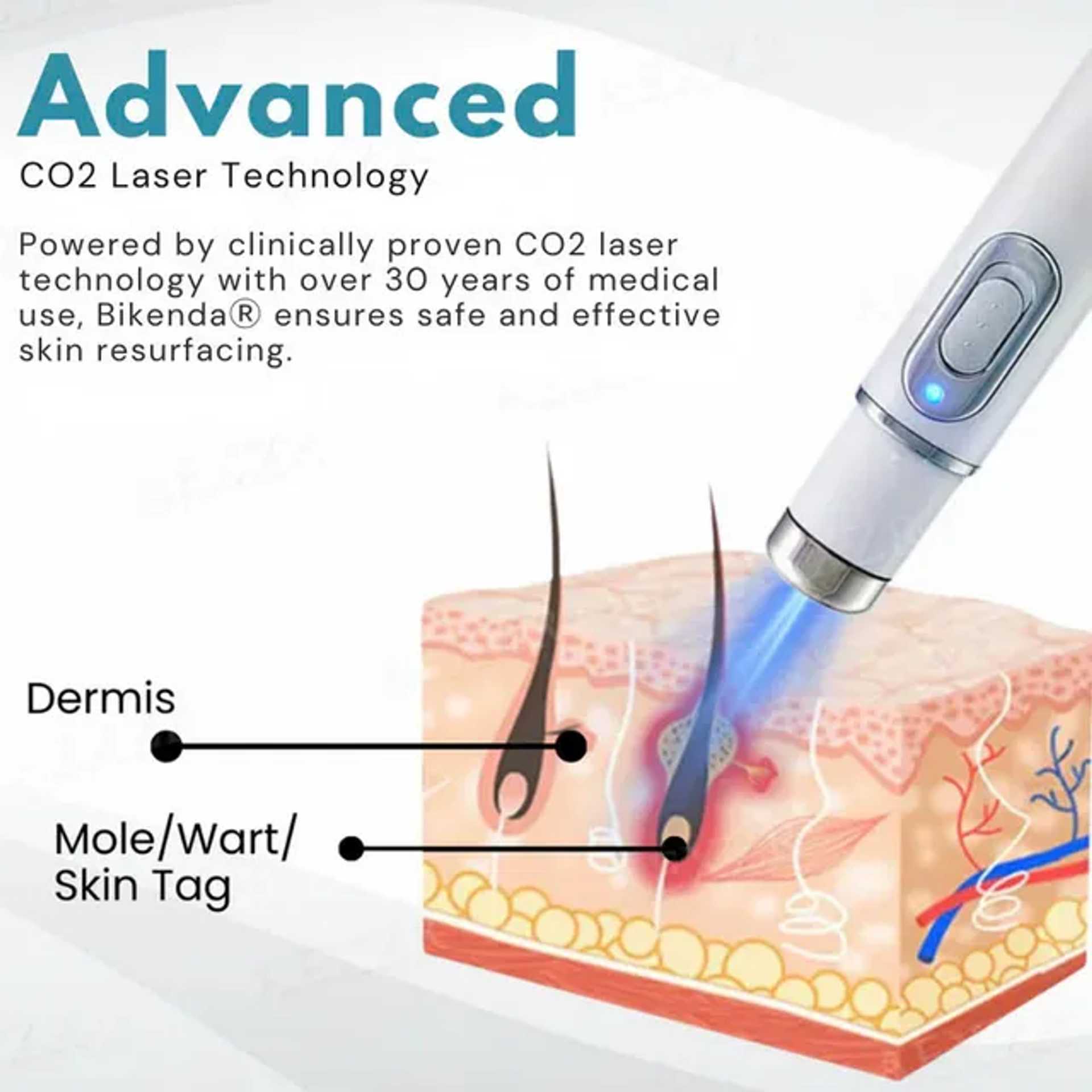 🔥Last Day Promotion 50% OFF💥Non-Invasive Mole and Wart Removal Laser Pen⚡️BUY 2 FREE SHIPPING