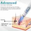 🔥Last Day Promotion 50% OFF💥Non-Invasive Mole and Wart Removal Laser Pen⚡️BUY 2 FREE SHIPPING