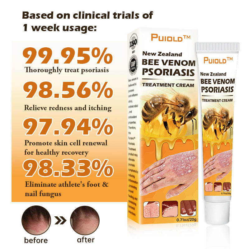 New Zealand Bee Venom Psoriasis Treatment Cream(Suitable for all skin conditions)- BUY 1 GET 1 FREE