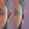 🔥Last Day Promotion 70% OFF🔥925 Silver - Aesthetic Ear Correction without Surgery