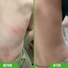 🔥🔥2025 HOT SALE - Bug Bite Thing Insect Bite and Sting Suction Tool