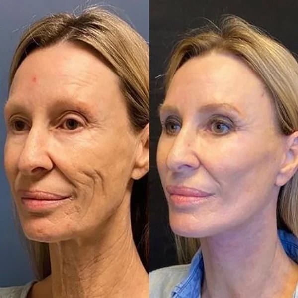 Aktion am letzten Tag: 49 % RABATT – 🔥Hibicty® Botox-Gesichtsserum