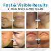 BENDCHARGE™ Non-Invasive Mole and Wart Removal Laser Pen