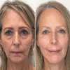 Last Day Promotion 70% OFF - 🔥Botox Face Serum