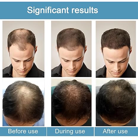 Microneedle Hair Regrowth System Hair Thickening Solution