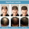 Microneedle Hair Regrowth System Hair Thickening Solution
