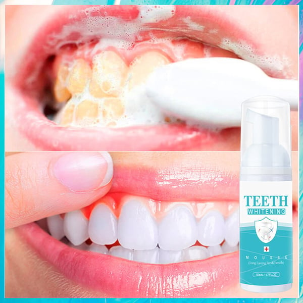 🔥LAST DAY SALE 49% OFF👨‍⚕Teeth Whitening Mousse--BUY 2 GET 1 FREE TODAY