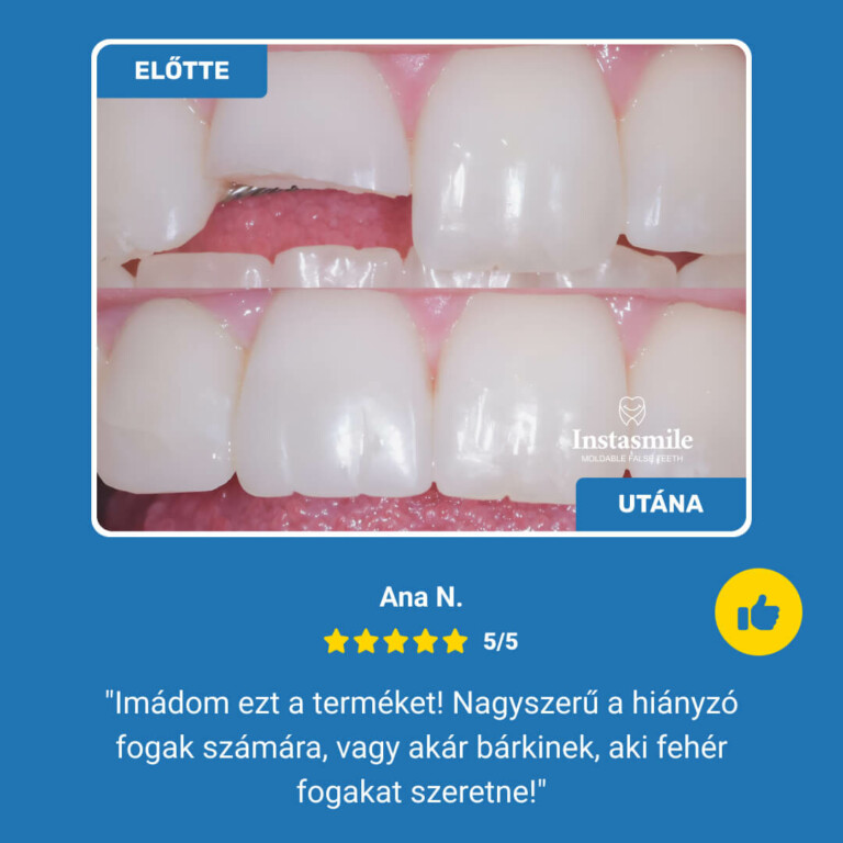 🔥Hot sale🔥INSTASMILE DENTAL REPAIR KIT [50 teeth can be repaired.]