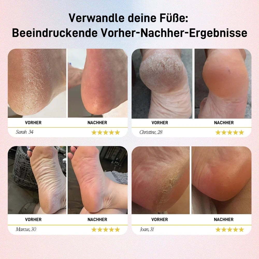 👍Schmerzfreie Fußpflege🔥Elektrischer Hornhautentferner für die Füße