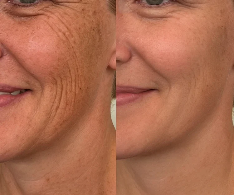 Dual Action Real Deep Collagen Sheets for both wrinkle smoothing and new or old scar fading