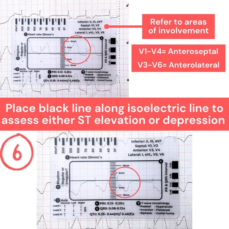 (🔥EARLY CHRISTMAS SALE - 49% OFF) ECG 7 Step Ruler, Buy 5 Get 2 Free (7 pcs) & Free Shipping