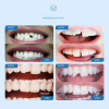 🔥Hot sale🔥INSTASMILE DENTAL REPAIR KIT [50 teeth can be repaired.]