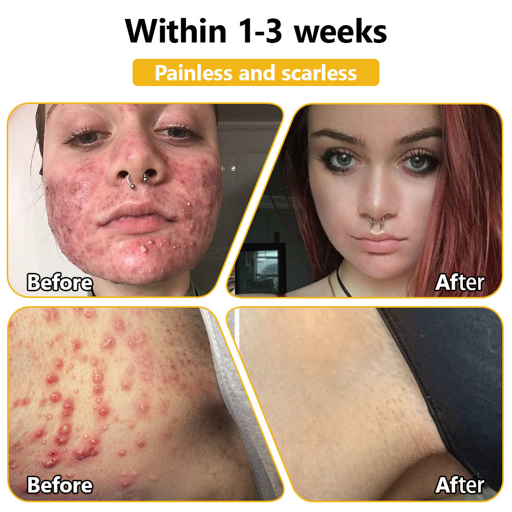 BENDCHARGE™ Bee Essence Skin Treatment Cream (AAD Recommended👨‍⚕️)