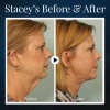 BeautyRest + Anti-Snoring V-Face Beauty Device-BUY 2 FREE SHIPPING