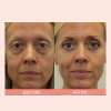 🔥Last Day 49% OFF - Pachyent® Retinol Eye Cream Stick🔥🔥BUY 2 GET 1 FREE
